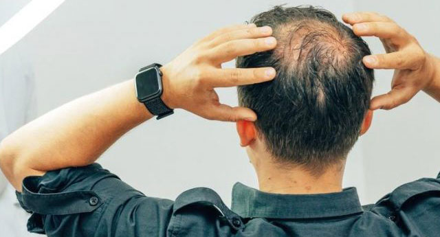 Saçı olmayanlar müjde: Bu bant dökülen saçları geri çıkarıyor
