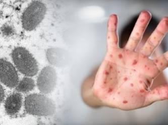 Maymun çiçeği bir kıtaya daha sıçradı