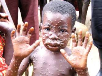 AB, 110 bin maymun çiçeği aşısı sipariş etti