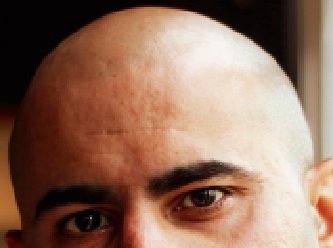 Saç uzamasını uyaran molekül keşfedildi