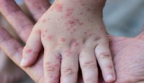 Korkutan 'kızamık' açıklaması: 'Covid’e benzemez, aşı yaptırın'
