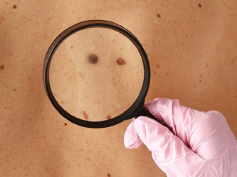 Cilt kanseri tedavisinde umut veren gelişme