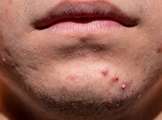 Bilim insanları umutlu; Akne problemi tarih olabilir