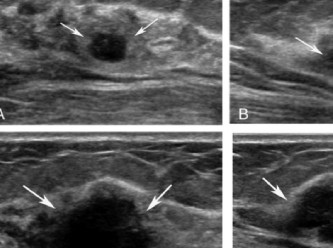 Tıp öğrencisi kanseri olduğunu ultrason dersinde öğrendi