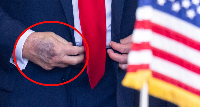 Trump’ın eline ne oldu? Beyaz Saray'dan açıklama geldi